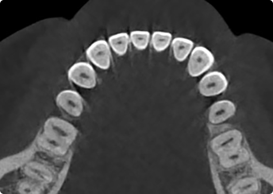 Before geometric distortion artifact reduction
